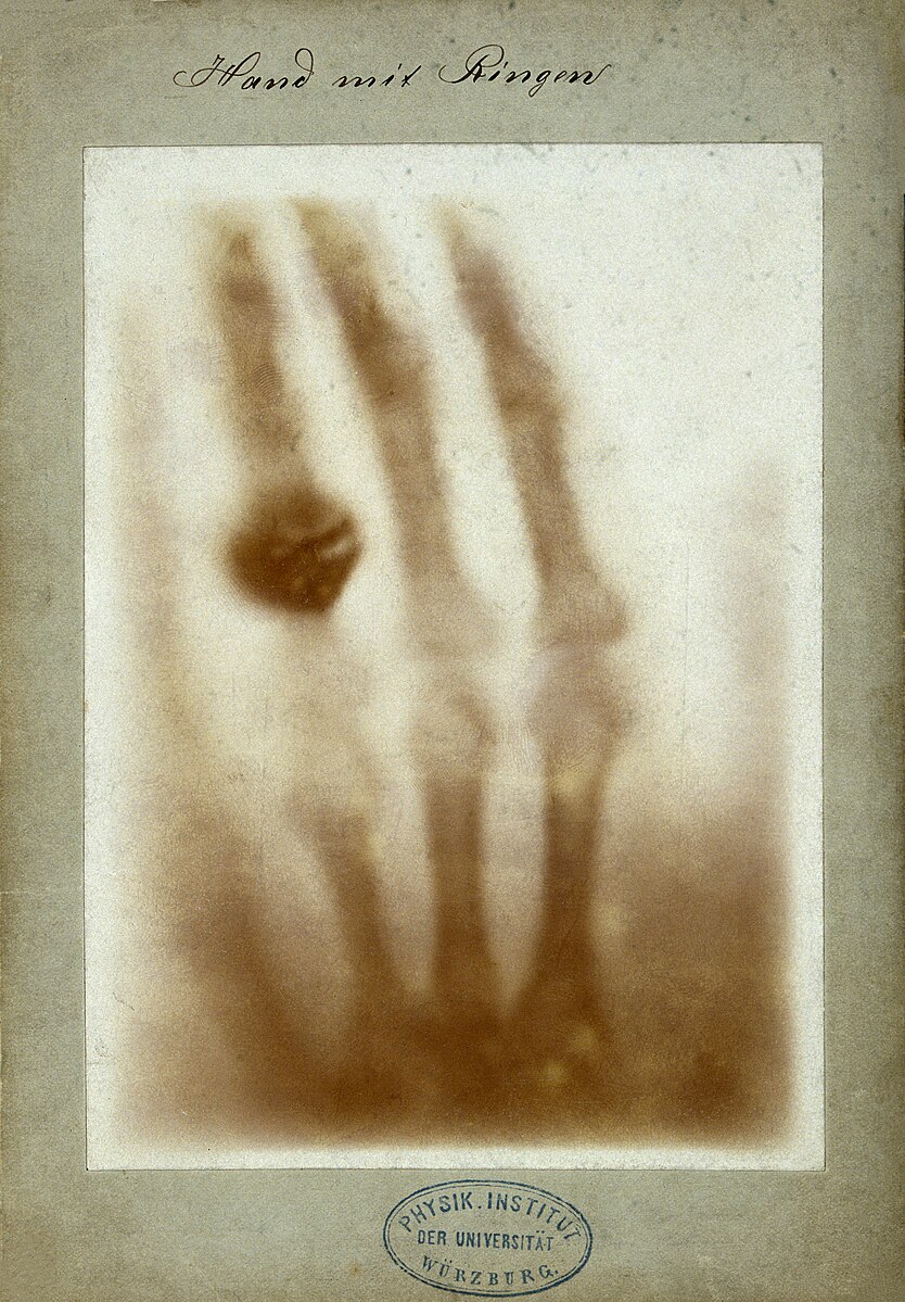 اولین عکس اشعه ایکس از انسان، دست آنا همسر رونتگن